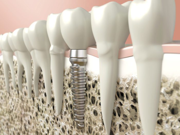 The Benefits of Dental Implants in Santa Monica CA