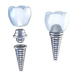 dental crown implant dr.dall'olmo