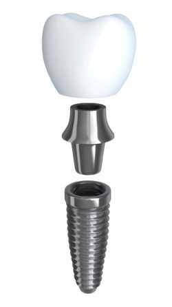 dental implant anatomy