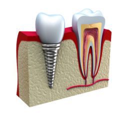 benefits of dental implants santa monica peridontist dr dall'olmo