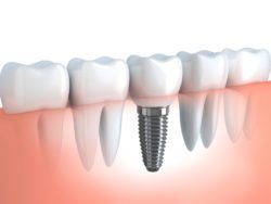 tooth extraction dental implant dr dallolmo
