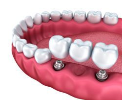 implant secured dental bridge dr dall'olmo