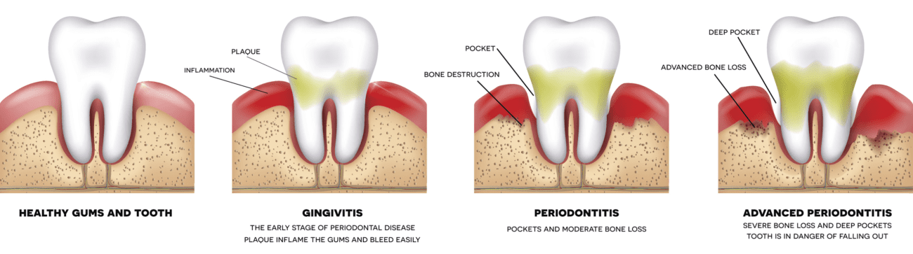 gum disease progression bleeding gums santa monica ca