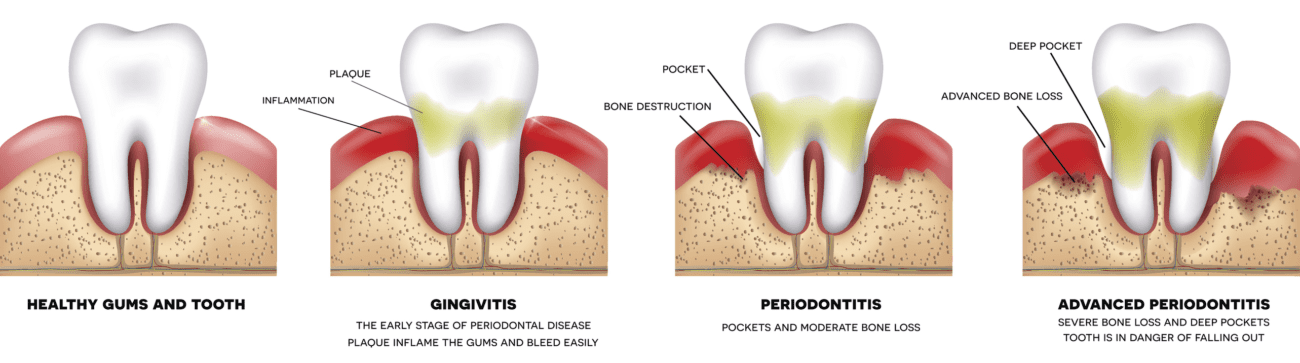 gum disease progression Santa Monica CA