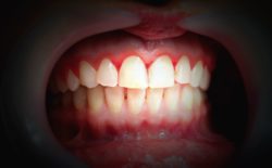 treat bleeding gums in Santa Monica California