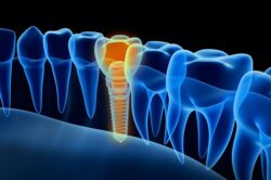 What Is Dental Implant Failure