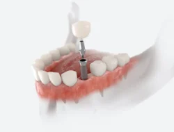 Dental Implants vs. Bridges: Which One? in Santa Monica, CA